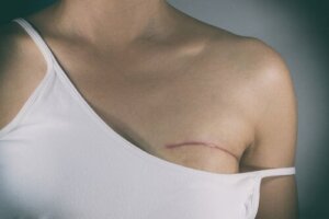 Types of Surgery in Breast Cancer Treatment
