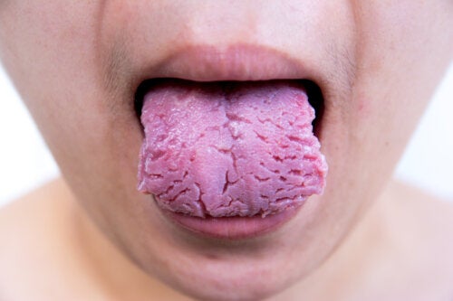Fissured Tongue: Causes and Treatment