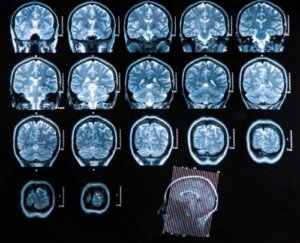 Brain Abscess: Diagnosis and Treatment