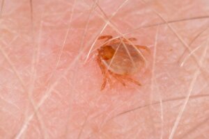 Rocky Mountain Spotted Fever: Symptoms and Treatments