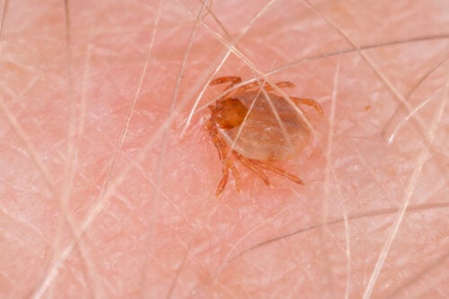Rocky Mountain Spotted Fever: Symptoms and Treatments