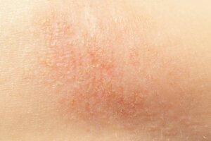 7 Natural Remedies for Dry Skin