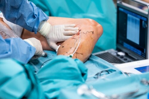Endolaser Surgery for Varicose Veins: What Is It and What Are Its Benefits?