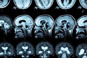 What Is Marchiafava-Bignami Disease? Symptoms, Causes and Treatments