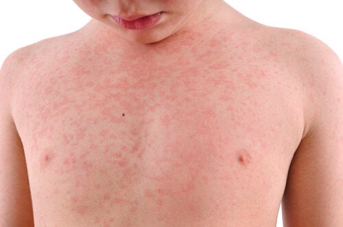 Sudden Exanthema: What Is It and How to Treat It?
