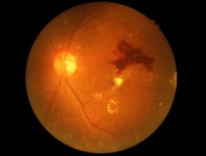 Vitreous Hemorrhage: Symptoms, Causes and Treatment