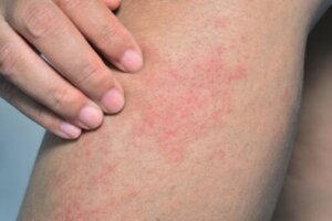 Mottled Skin: What Is It and What Causes It?