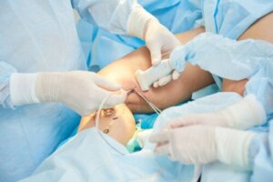 Sclerotherapy for Varicose Veins: How is it Performed?