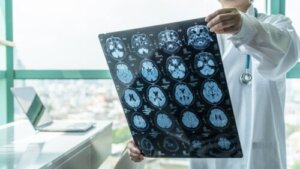 What Is a Stroke Unit?