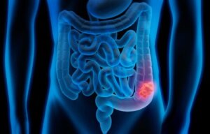Spanish Scientists Discover Cells that Cause Relapse in Colon Cancer