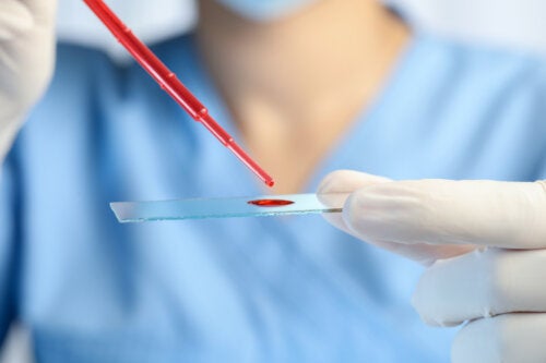 Chronic Eosinophilic Leukemia: Symptoms, Diagnosis and Treatment