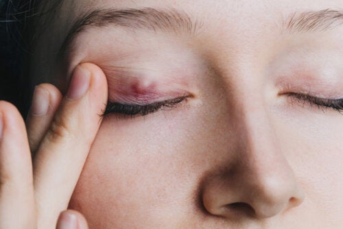 Chalazion: Everything You Need to Know