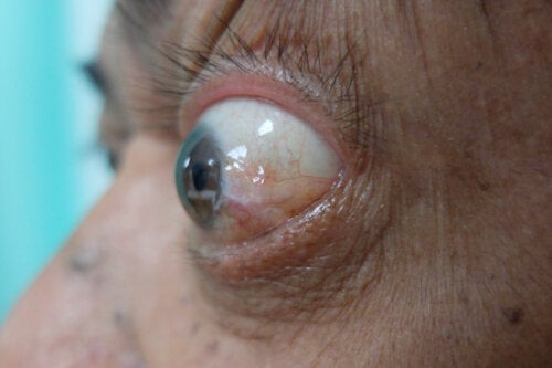 Thyroid Eye Disease: Symptoms and Treatments