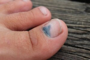 Causes and Treatment of Onycholysis