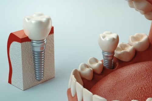 What is Osseointegration of Dental Implants?