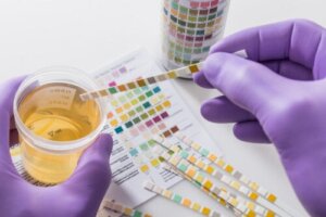 Fat in Urine: Possible Causes and What to Do