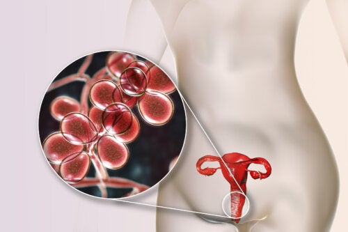 Yellow Vaginal Discharge: 5 Causes and Treatment