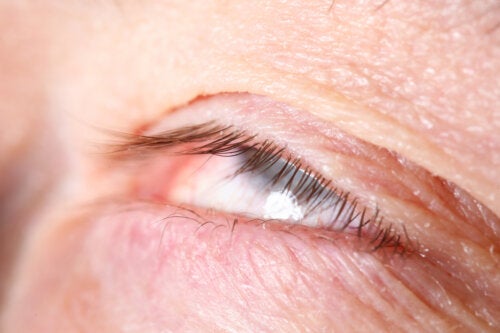 Alterations in the Position of the Eyelids