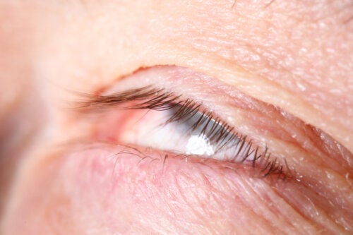 Alterations in the Position of the Eyelids