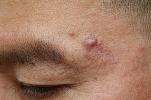 Reasons for a Hard Lump Under the Skin