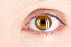 What Is Fuchs' Dystrophy and Why Does It Appear?