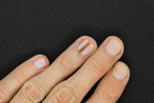 Nail Melanonychia: Causes and Treatments