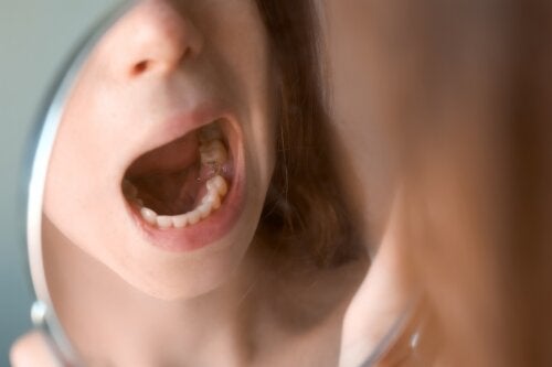 Papilloma in The Mouth: Signs and Prevention