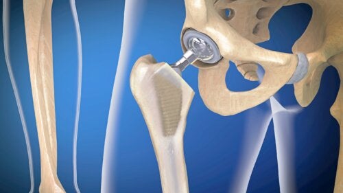 Joint Prostheses Infection: Why Does It Occur?