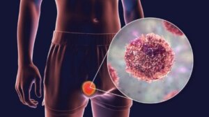 Teratoma Tumors: Types, Symptoms and Treatment