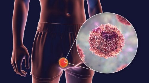Teratoma Tumors: Types, Symptoms and Treatment