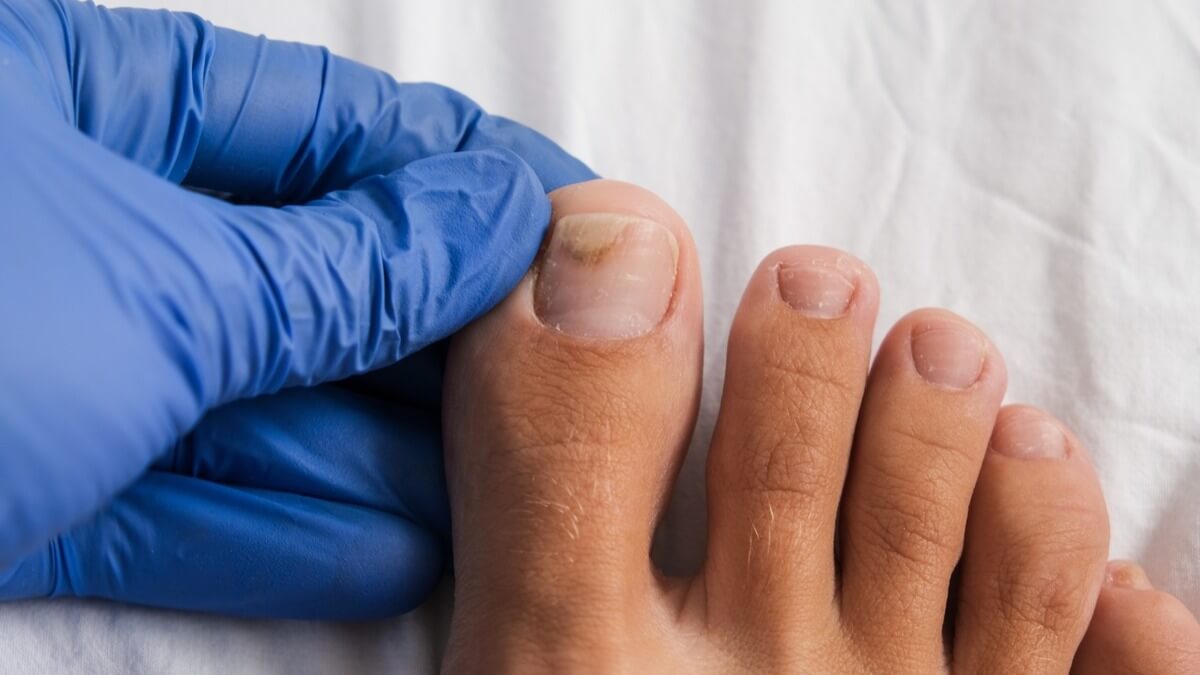 How one can Eliminate Toenail Fungus